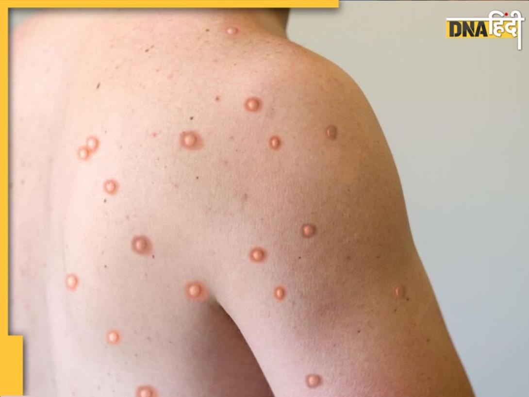 Monkeypox Virus Attack: क्या फिर से लॉकडाउन कराएगा मंकीपॉक्स? जानिए किस अंग को करता है प्रभावित और इससे कैसे बचें
