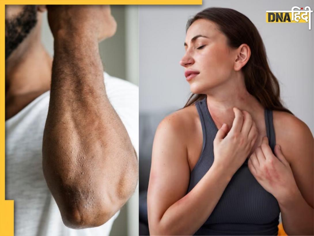 Health Sign On Neck-Elbow: कहीं आपकी गर्दन और कोहनी पर तो नहीं दिख रहे हैं ऐसे निशान? हो सकती है ये बीमारी