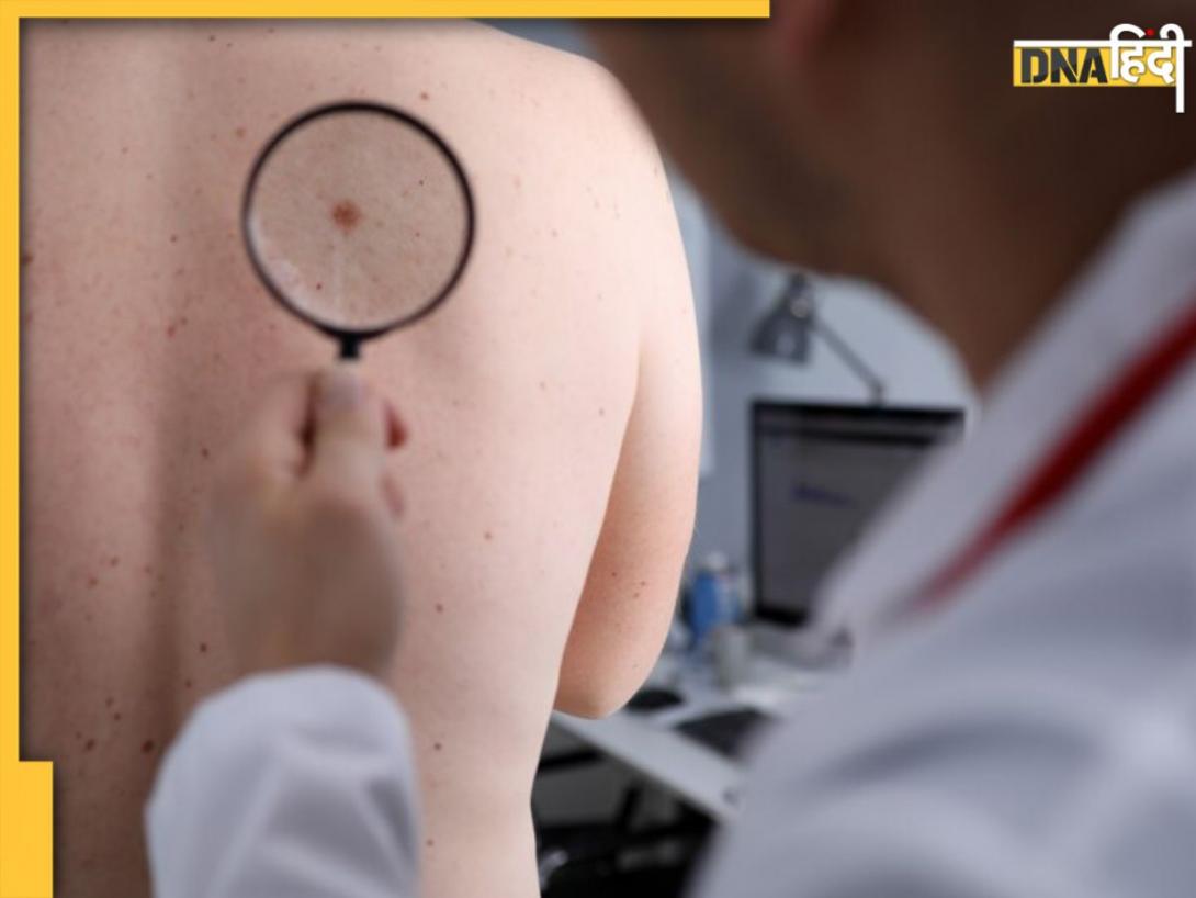 त्वचा पर दिखने वाले ये 5 लक्षण हो सकते हैं Skin Cancer के संकेत, भूलकर भी न करें नजरअंदाज