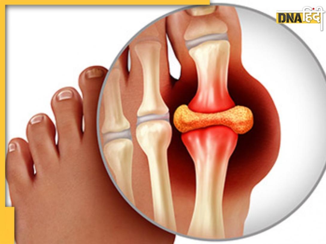 जोड़ों में चिपके Uric Acid को जड़ से खींच लेगी ये देसी चीज, ऐसे खाएंगे तो मिलेगा डबल फायदा