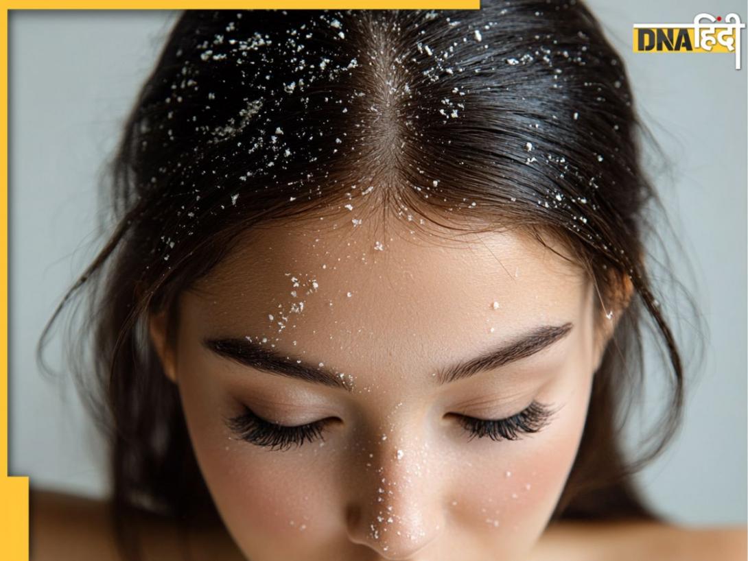 Dandruff से छुटकारा पाने के लिएअपनाएं ये आयुर्वेदिक नुस्खे, कुछ ही दिनों में दिखने लगेगा असर