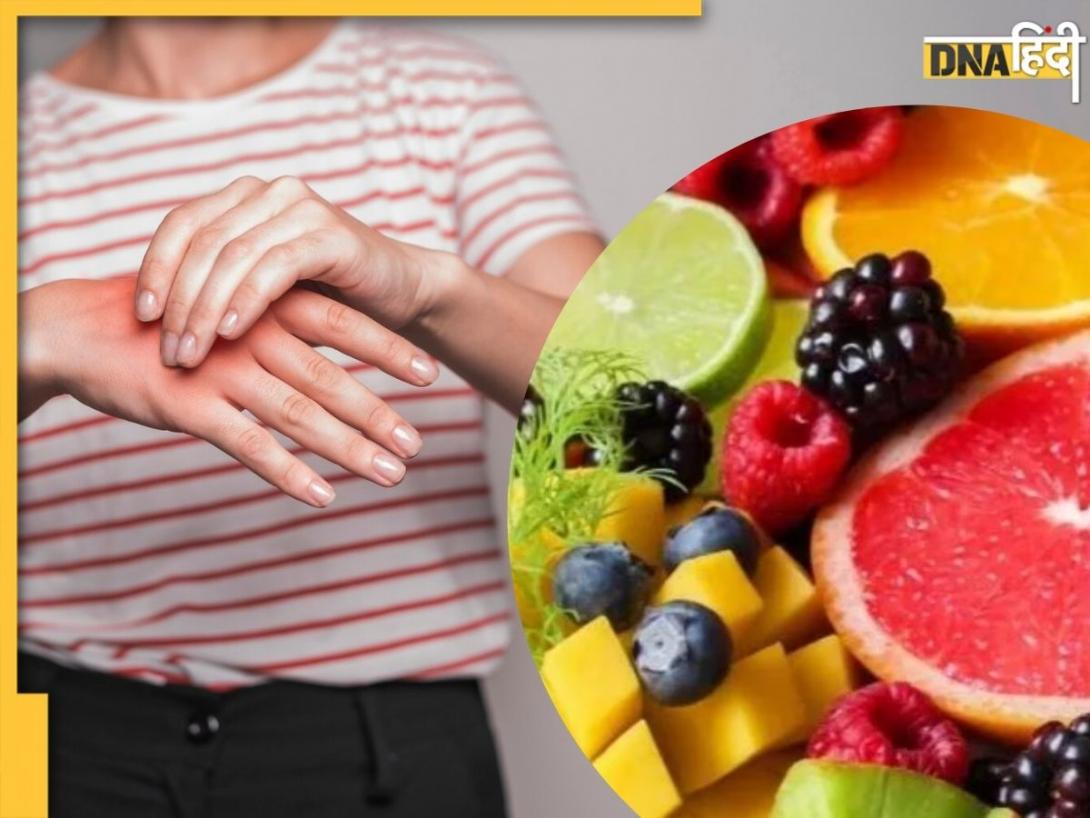 बिल्कुल नहीं बढ़ेगा High Uric Acid, सिर्फ खाना शुरू कर दें ये 5 फल, दर्द और सूजन से मिलेगी राहत
