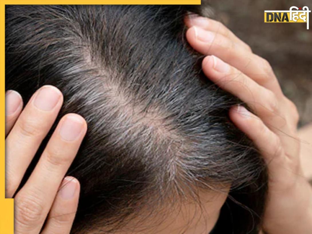 White Hair Remedies: सफेद बालों को नेचुरली काला करेंगे ये 5 घरेलू उपाय, कई हेयर प्रॉब्लम से भी मिलेगा छुटकारा