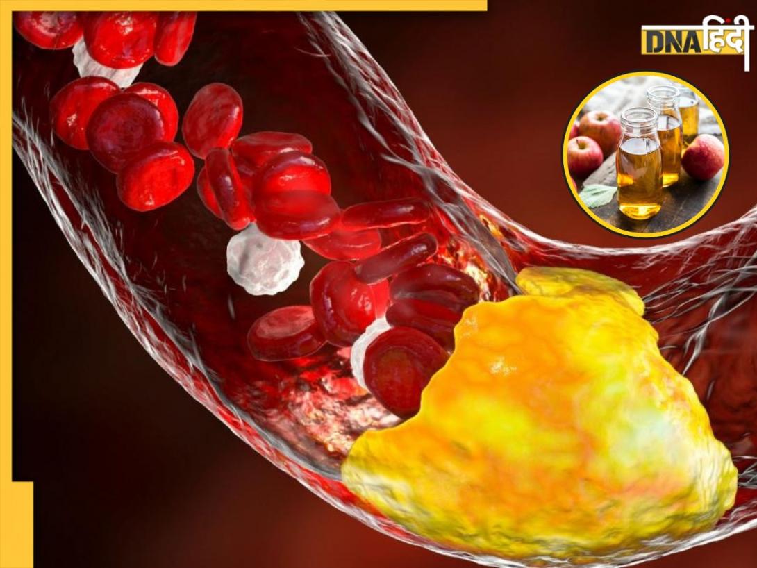 Cholesterol से छुटकारा दिला सकता यह असरदार नुस्खा, सुबह खाली पेट लेने से मिलेंगे कई फायदे  