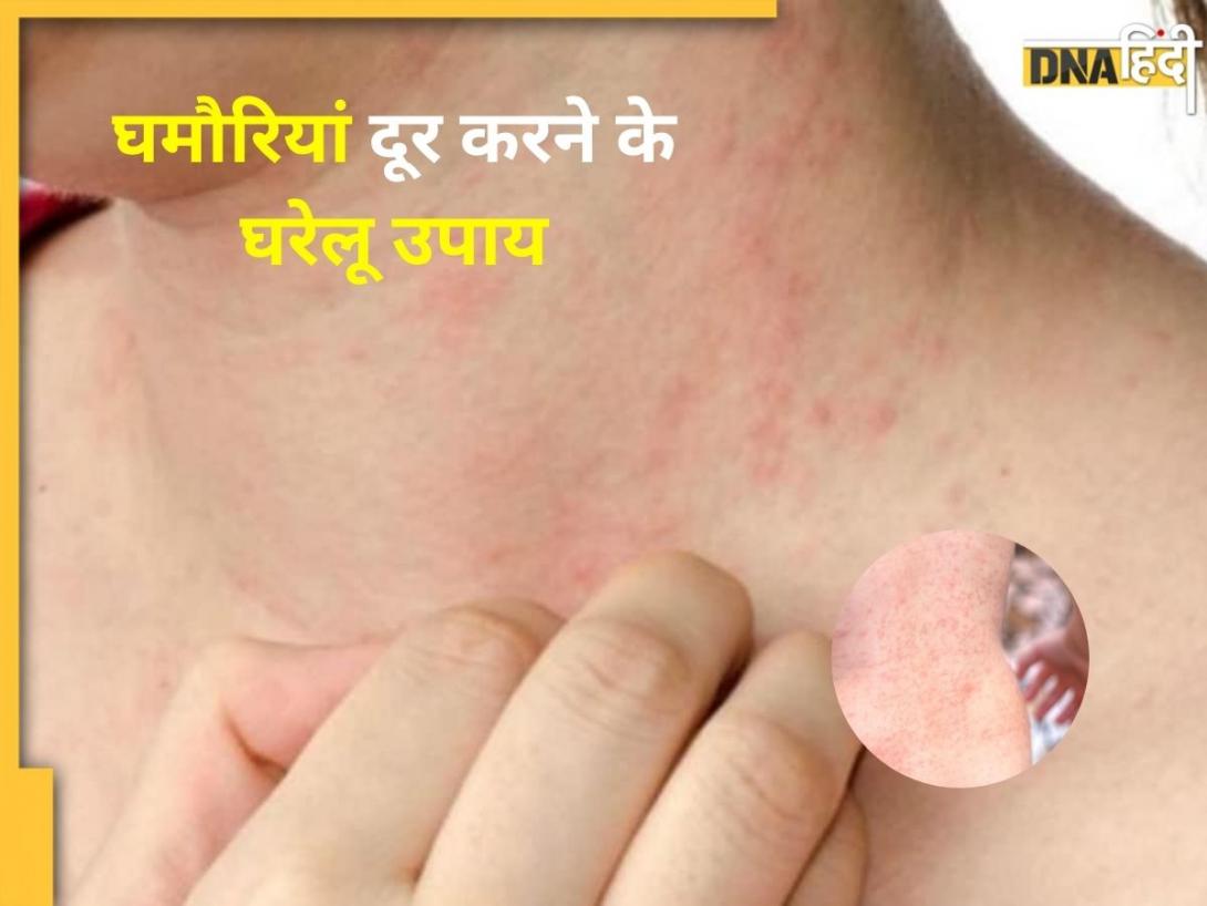 गर्मी और पसीने के कारण परेशान कर रही हैं घमौर‍ियां, इन 5 घरेलू नुस्खों से दूर होगी हीट रैश की समस्या