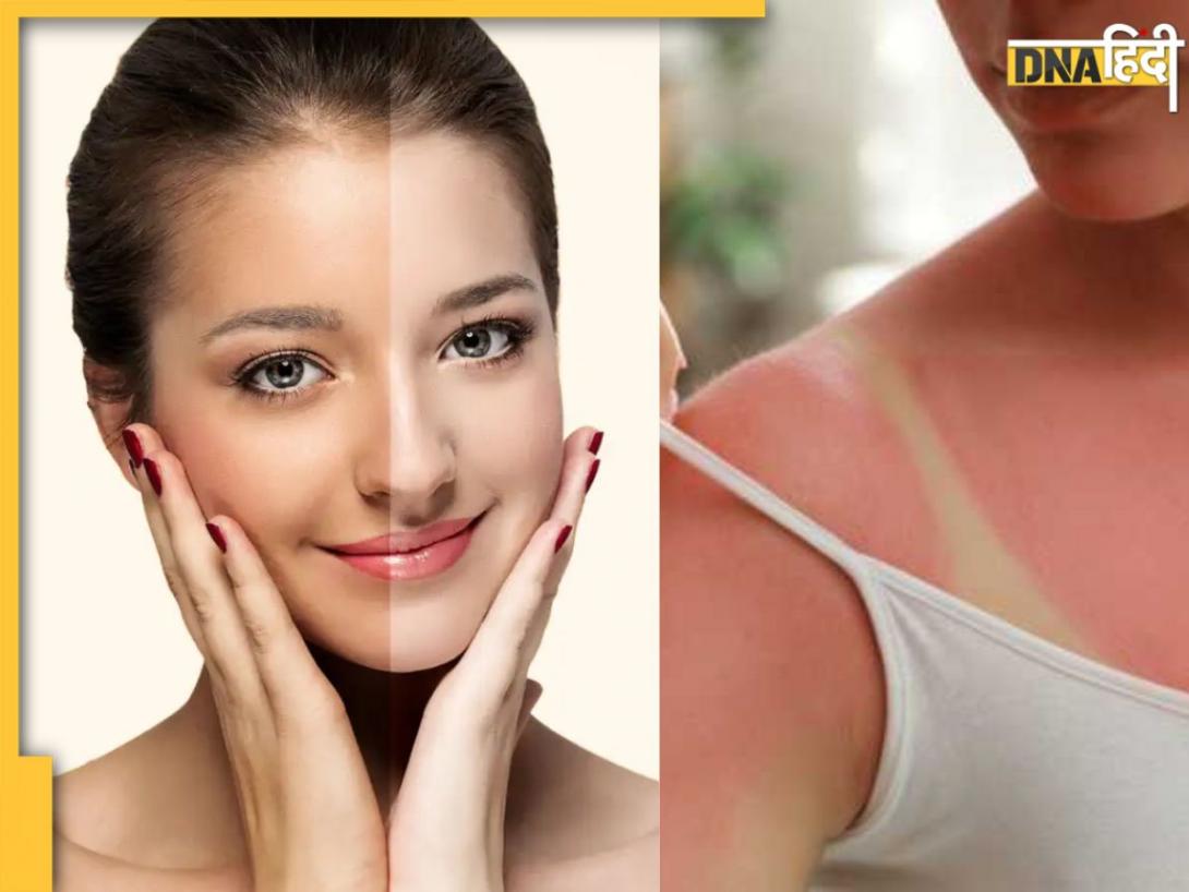 धूप में काली पड़ गई स्किन को कैसे करें साफ? Sun Tanning हटाने के लिए लगाए ये 5 तरह के उबटन