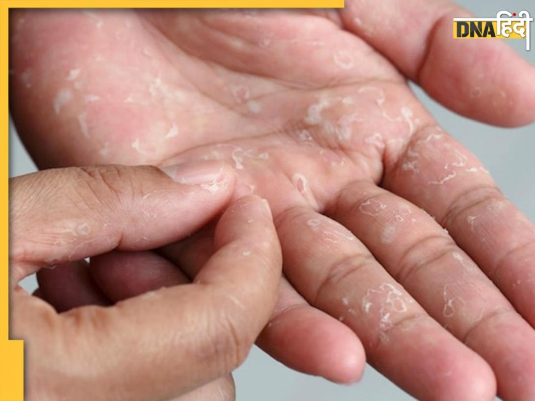 छिलके जैसी उतरने लगी है हाथों की स्किन? जानें क्या हैं Skin Peeling के 7 बड़े कारण