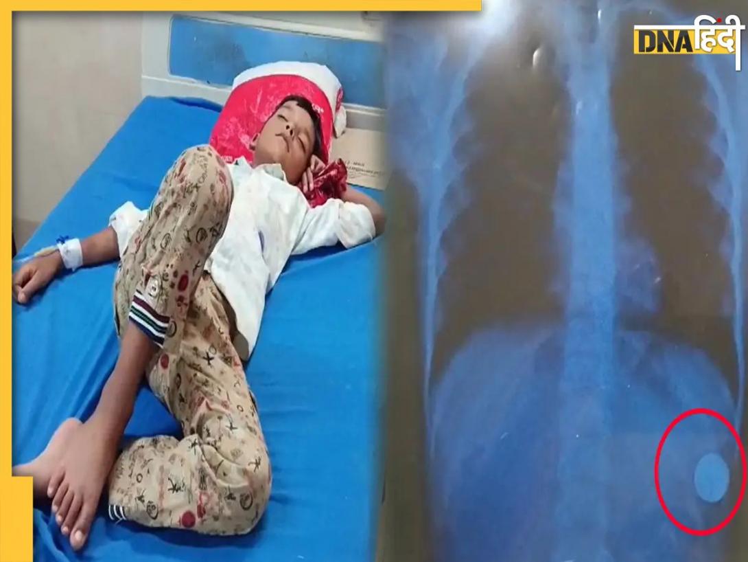 Kota News: खेल-खेल में 8 साल के बच्चे ने सेल(बैटरी) निगल ली, AI से ढूंढता रहा इलाज, फिर ऐसे बची जान