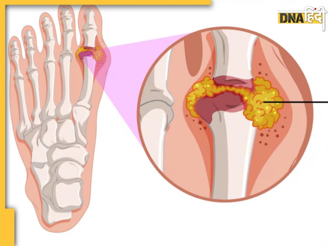 जोड़ों में दर्द ही नहीं, High Uric Acid से इन बीमारियों का भी बढ़ता है खतरा