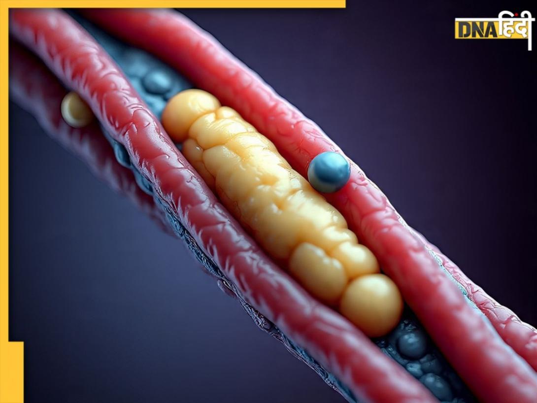 इन संकेतों से पहचानें High Cholesterol के लक्षण, हार्ट अटैक के खतरे से बच सकते हैं आप