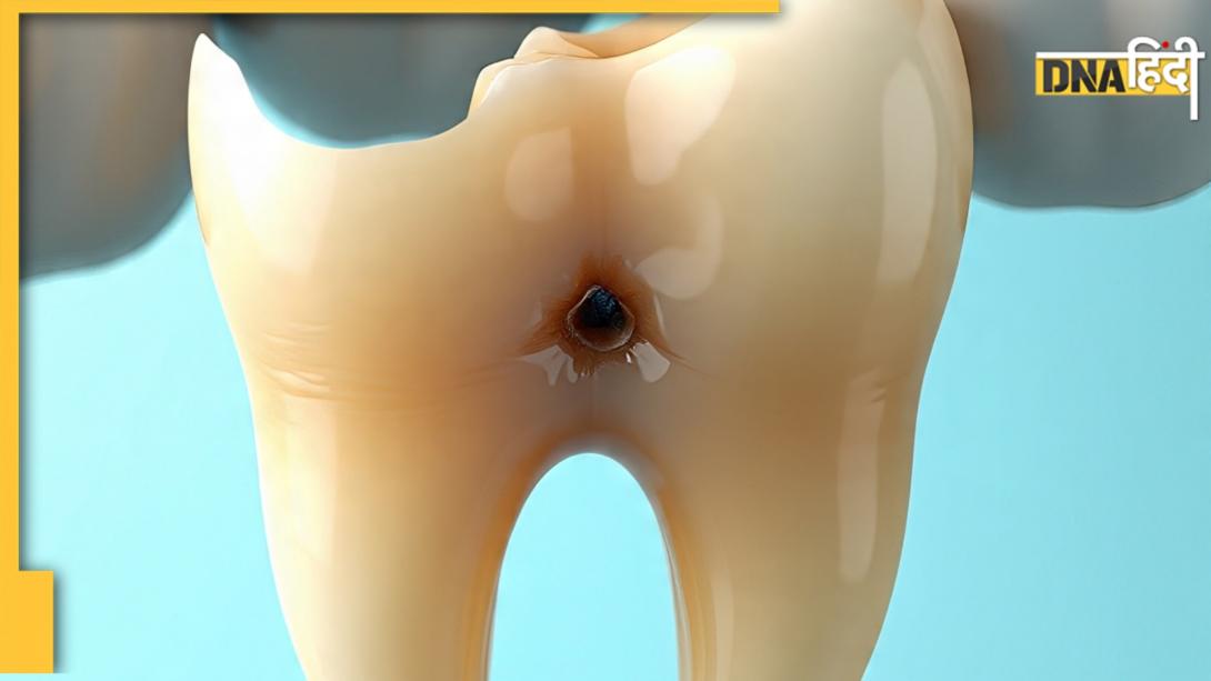 Tooth Cavity Treatment: खाने के बाद चबा लें ये 1 चीज, दांतों पर कभी नहीं लगेगा कीड़ा