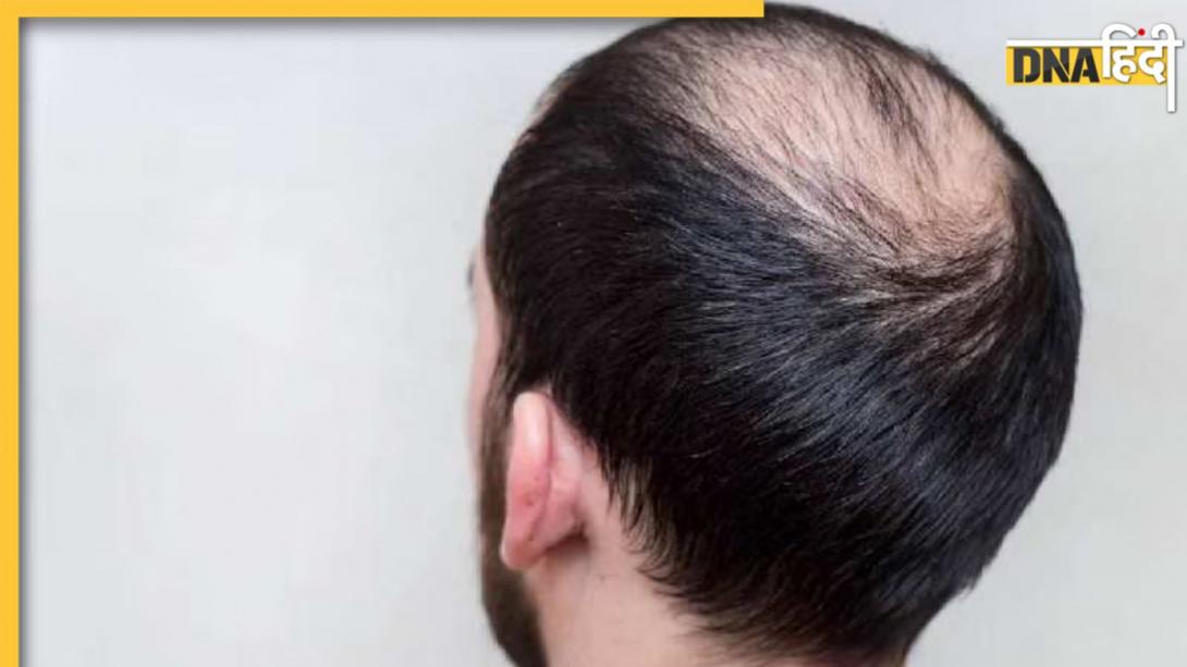 Hair Regrowth Remedies: बालों के झड़ने से गंजी होती जा रही है खोपड़ी, इन घरेलू उपायों से बढ़ेगी हेयर ग्रोथ