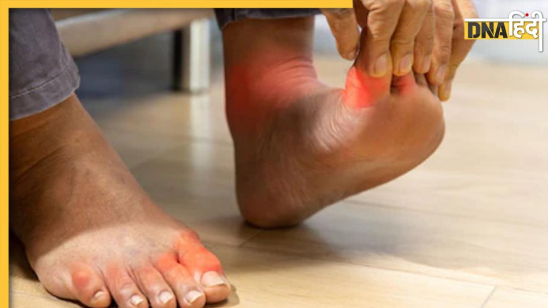 High Uric Acid: यूरिक एसिड लेवल कम करने के लिए इन 7 बातों का रखें ध्यान, हफ्तेभर में दिखने लगेगा फायदा