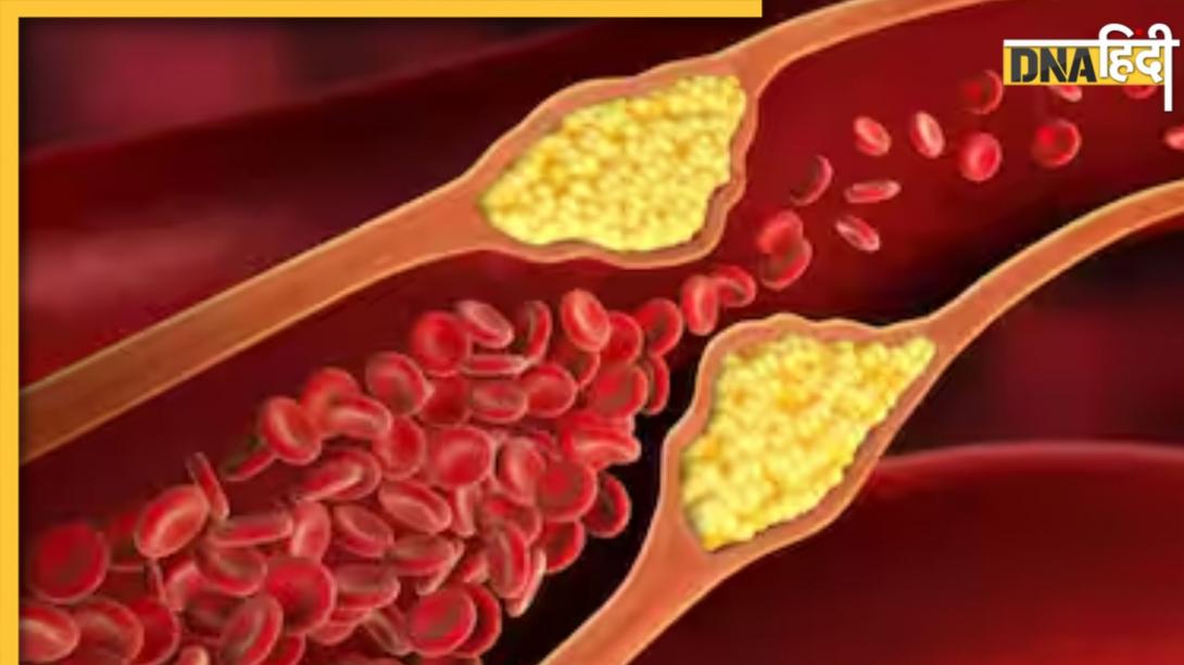 Cholesterol Control Diet: कोलेस्ट्रॉल से ब्लॉक हुई नसों को खोलने के लिए खाएं ये 6 पीली चीजें, हमेशा हेल्दी रहेगा हार्ट