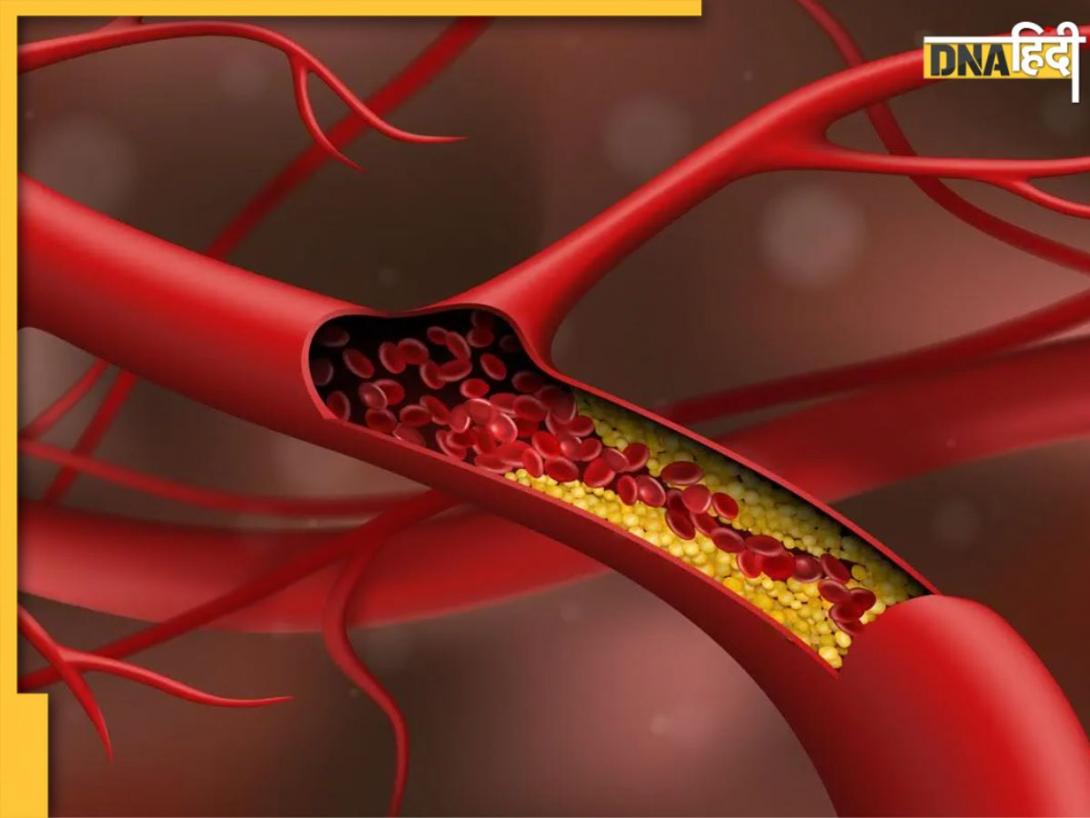 High Cholesterol: कोलेस्ट्रॉल बढ़ने पर शरीर के इन 5 हिस्सों में होता है दर्द, इन लक्षणों को न करें इग्नोर