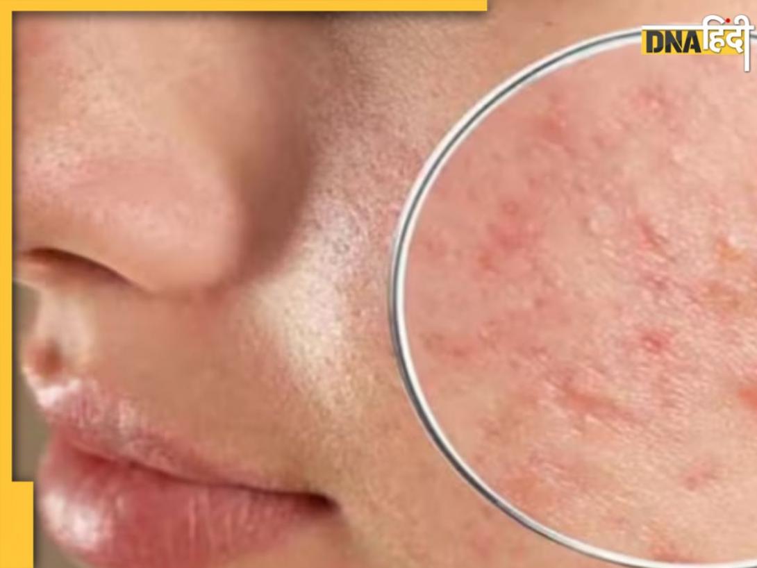 Dead Skin Cells के कारण त्वचा पर नजर आता है कालापन, इन चीजों से करें चेहरे पर जमा गंदगी की सफाई