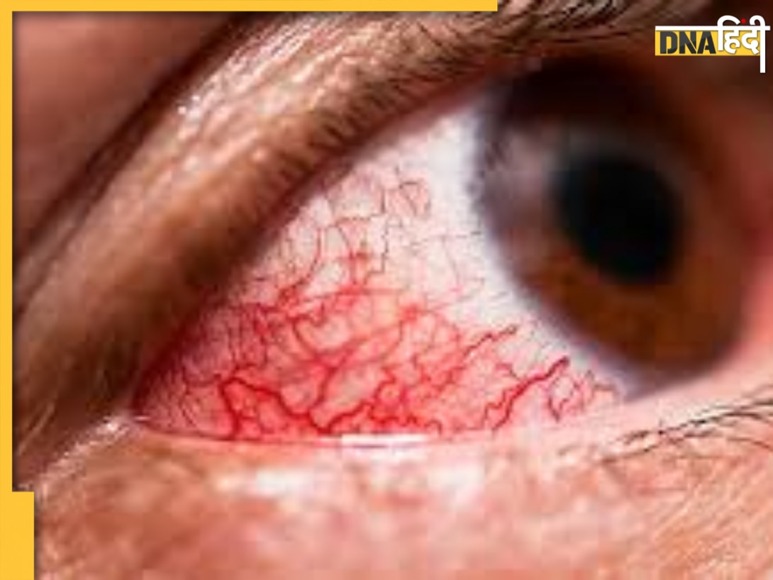 प्रदूषण से आंखें हो रही हैं लाल? देखभाल के लिए अपनाएं ये 3-स्टेप फॉर्मूला, ठंड के अटैक से भी होगा बचाव