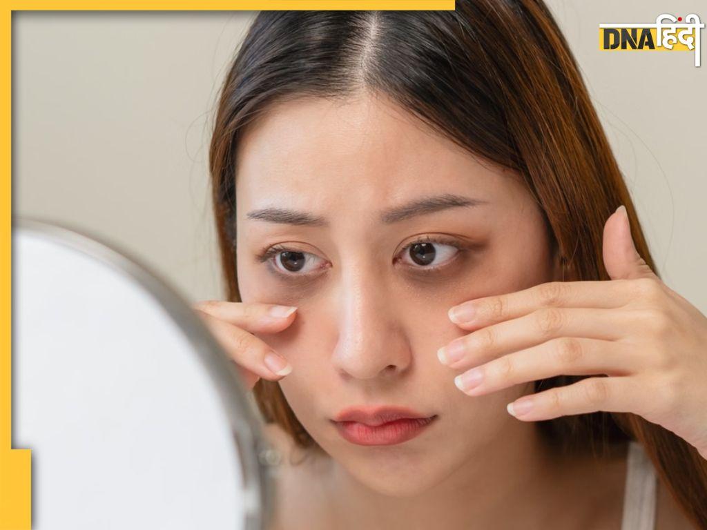 Dark Circles Causes: आंखों के आसपास के काले घेरे देते हैं इन शारीरिक समस्याओं का संकेत, इग्नोर करना पड़ सकता है भारी