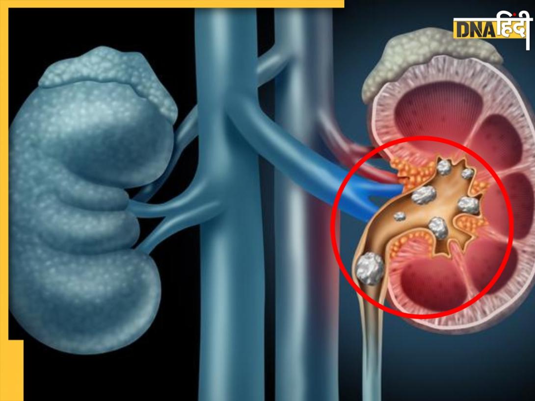 कहीं आपकी ये आदतें तो नहीं किडनी स्टोन की जिम्मेदार? जानिए इससे बचने के आयुर्वेदिक उपाय 