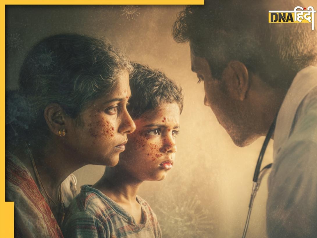 Chickenpox: किसे और क्यों होता है चिकनपॉक्स? भारत के इस राज्य में बढ़े मामले, जानिए क्या है ये बीमारी 